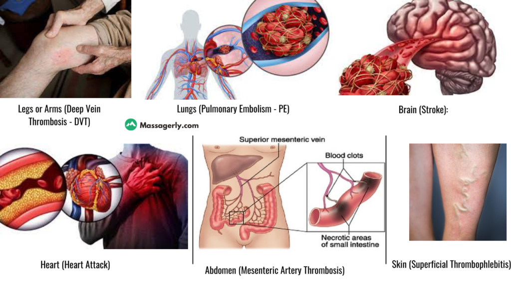 Symptoms of Blood clots in Different Body Parts