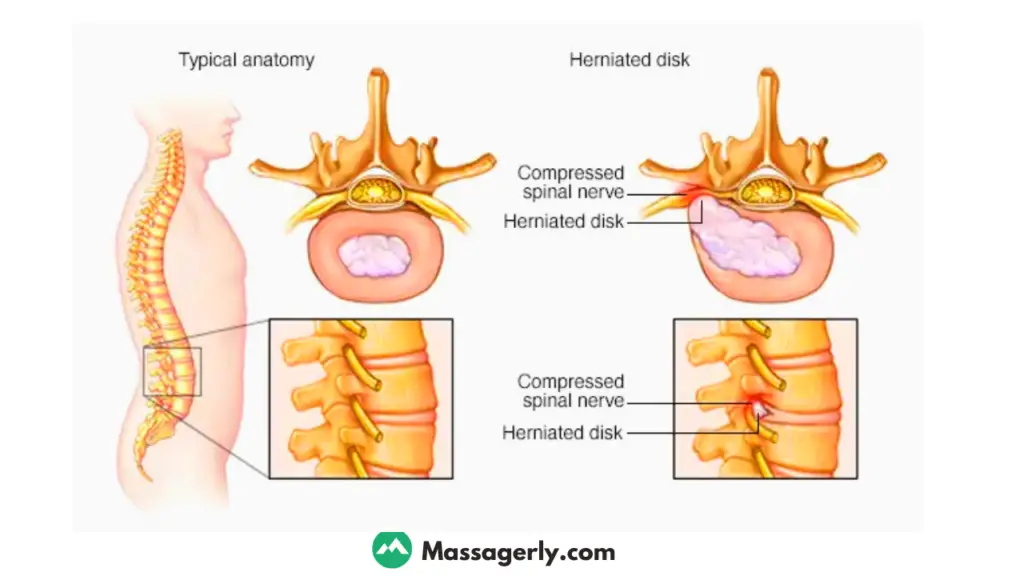 Can massage make herniated disc worse? 