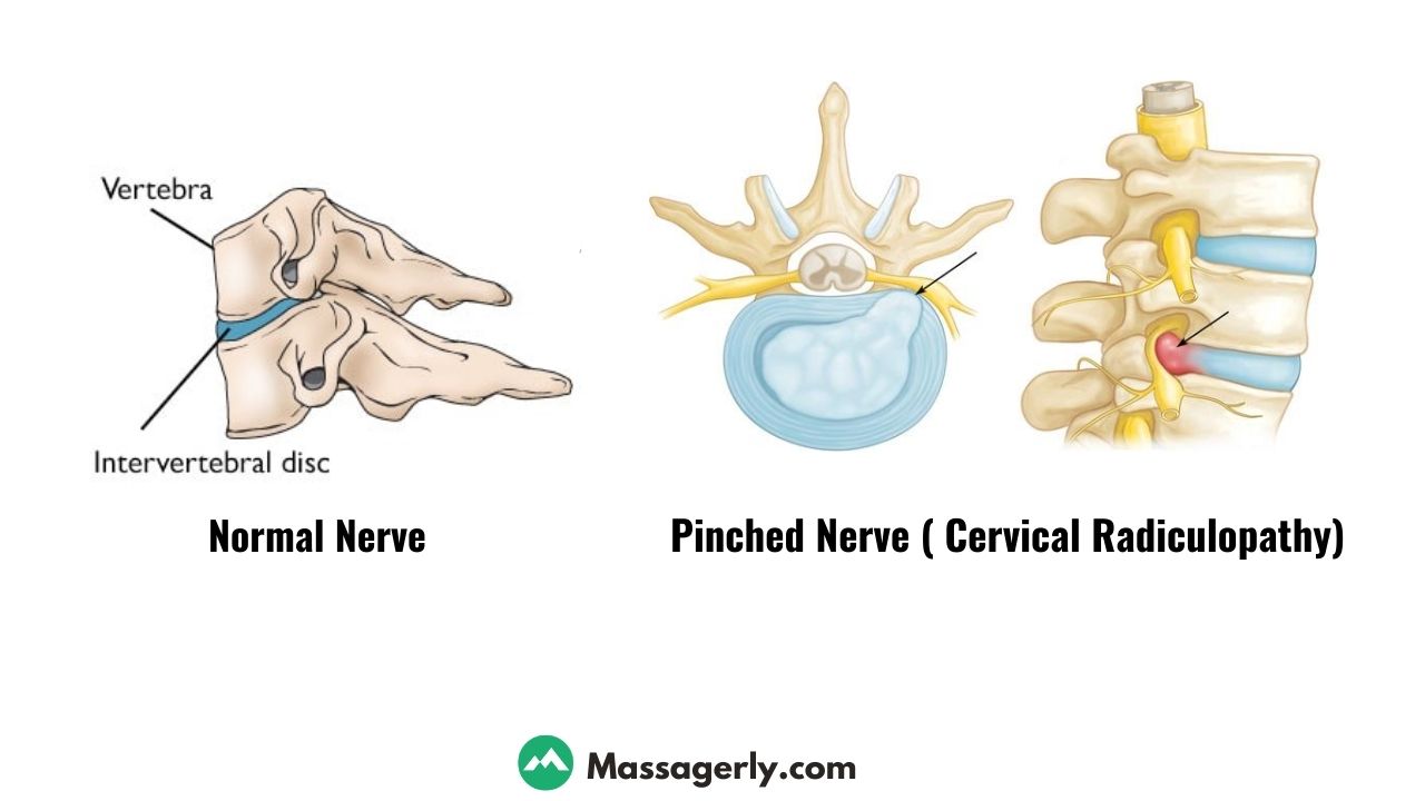 can massage help a pinched nerve