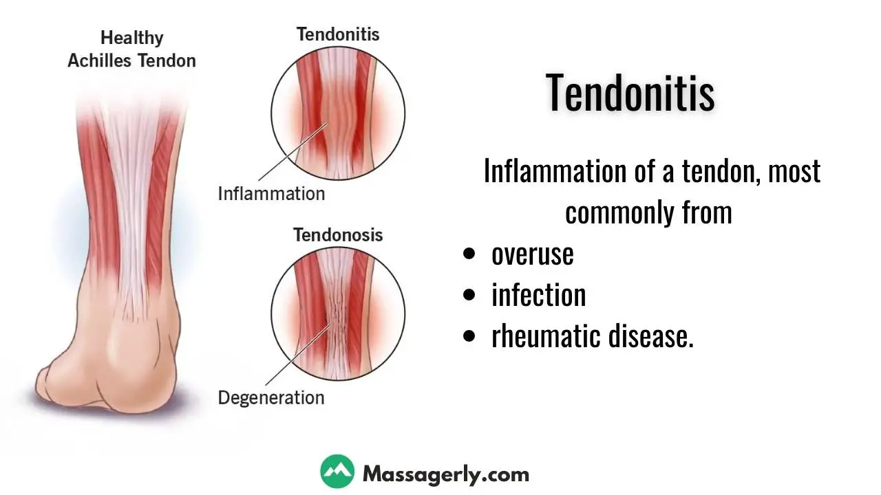 massage tendonitis

